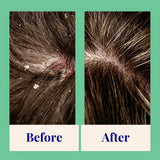 Exfoliating Shampoo For Loose Dandruff Flakes Tea Tree & Salicylic Acid 70g
