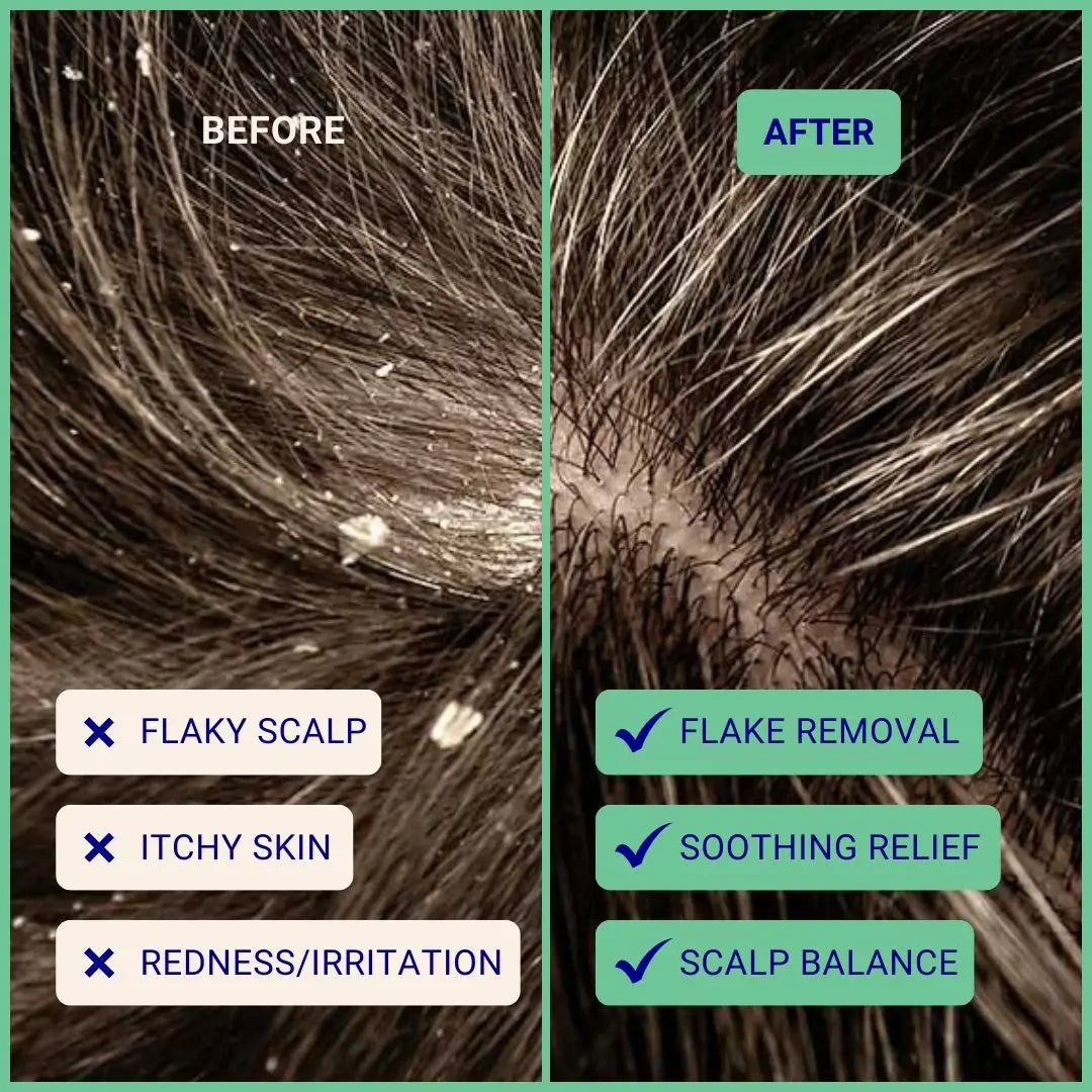 Exfoliating Shampoo For Loose Dandruff Flakes Tea Tree & Salicylic Acid 70g
